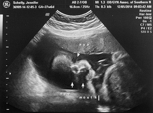 2014-12-05 Ultrasound Pictures